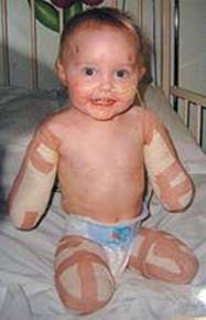 STILL SMILING: Ellie-May Challis, two, who lost both arms and legs to meningitis (c)